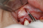 Fig 3. Apical incision using a 15c blade.