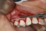 Fig 4. Elevating the facial tissue through apical incision with a Fedi chisel.