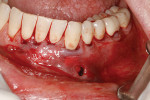 Fig 13. Case 2, immediate post-surgery; apical incision was evident.