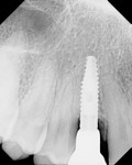 Fig 1. Radiograph at the time of restoration insertion appeared to show crestal bone loss.