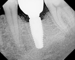 Fig 3. Radiograph at final restoration insertion appeared as if there was crestal bone loss.