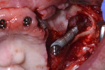 Fig 19. Zygomatic implant placed, left zygoma.