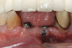 Figure 1  Implants were placed in the area of teeth Nos. 24 and 25.