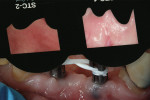 Figure 3  For stability, the clinician wrapped dental tape around the implants.