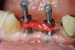 Figure 4  Primopattern LC Gel was applied over the dental tape.