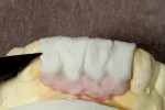 Figure 7  Pink porcelain and enamel overlay closely mimicked the natural teeth.