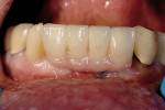 Figure 14  The implant bridge in the mouth.