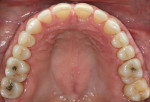 Figure 5  Preoperative maxillary occlusal view.