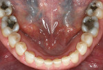 Figure 6  Preoperative mandibular occlusal view.