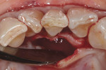 Flap reflected from tooth No. 24 permitting visualization of the lingual root prominence and thin plate of alveolar bone.