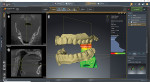 Image of the digitally scanned teeth meshed with the CBCT scan of the bite, which was used to communicate the treatment position to the laboratory.