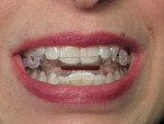 The final milled appliance in the patient’s mouth, positioning her into the optimal therapeutic bite to treat her OSA.