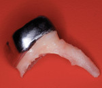 Nine-year postoperative photograph of a preformed stainless steel crown fitted to a primary second molar. The tooth was extracted because of premolar eruption.