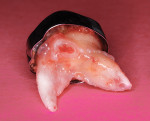 Nonadapted preformed stainless steel crown. The tooth was extracted at an emergency appointment because of a dentoalveolar abscess that formed within a year after crown placement.