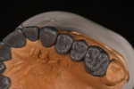 Fig 6 through Fig 9. To ensure that the new maxillary provisional restorations would fit the mounting, composite was spot-etched into place using the template of the mandibular arch.