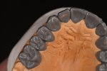 Fig 6 through Fig 9. To ensure that the new maxillary provisional restorations would fit the mounting, composite was spot-etched into place using the template of the mandibular arch.