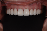 Fig 11 and Fig 12. The provisionals in place after several weeks in the new OVD. Note the spot-bonded composite visible on teeth Nos. 21, 28, and 29.