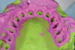 Fig 13. A PVS impression is made for the prepared maxillary arch.