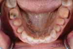 Fig 19. Preparation of the mandibular arch prior to the anterior teeth being fully prepared.