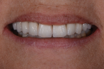 Fig 17 and Fig 18. A bisque bake try-in is completed to evaluate the esthetic outcome and allow the patient to confirm the desired shape and color.