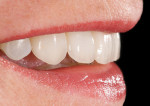 Figure 17  Right lateral view of e.max veneers.