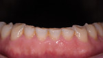 Fig 3. Preoperative, note mandibular incisors showing attrition and erosion.