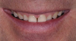 Fig 7. Preoperative, close-up smile showed small size and proportion of teeth, visible tissue display, and diastema between central incisors.