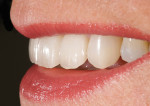 Figure 19  Left lateral view of final e.max veneers.