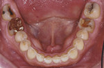 Fig 6. Preoperative, note defective restoration on tooth No. 18 and questionable restoration on tooth No. 30. Teeth Nos. 19 and 31 had a
hopeless prognosis. Teeth Nos. 20 through 28 showed signs of erosion and attrition.