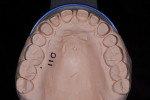 Fig 9. Maxillary model of prepared teeth showed conservative posterior adhesive and anterior cohesive tooth preparations.
