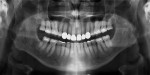 Fig 14. Postoperative panoramic radiograph showed no interproximal reduction on maxillary posterior teeth and radiopaque maxillary anterior zirconia restorations.
