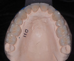 Fig 11. Maxillary posterior monolithic lithium-disilicate restorations and layered zirconia anteriors.