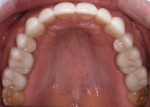Fig 12. Postoperative, note improved arch form, added volume to the facial of teeth, and palatal surface of anteriors covered and restored to protect areas of erosion and attrition.