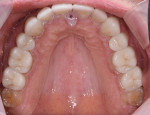 Fig 15. Maxillary restorations seated with deprogrammer in place to achieve bilateral simultaneous occlusion.