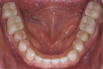 Fig 16. Blending of shade and contour from molar crowns to bicuspids and anterior composite restorations, which covered all areas of erosion.