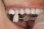 Figure 1  The value is too high on the MZ crown on tooth No. 3.