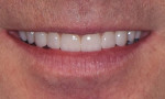 Fig 17. Postoperative, note closing of the diastema, more appropriate tooth proportions, and filled out buccal corridor