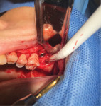 Fig 9. Fully inserted implant prior to placement of the healing cap.