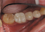 Figure 2  The value is too high on the MZ crown tooth No. 30.