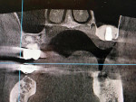 Fig 11. Alternate immediate postoperative CT scan in front view confirming the sinus membrane lift produced by the implant and bone graft material.