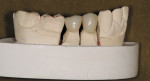 Figure 3  Early MZ crowns before correcting the shape and contour.