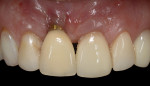 Fig 1. Intraoral view of a patient at 3-year recall who had received immediate replacement of tooth No. 8 with a tapered implant. Note gingival recession and tissue discoloration associated with the single-tooth implant and restoration.
