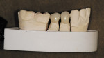 Figure 4  Early MZ crowns after correcting the shape and contour and final polishing