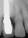 Fig 5. Periapical digital radiograph of tooth No. 8 described in Fig 4 showing close proximity to adjacent tooth No. 7. Even with a platform-switched implant design, the horizontal component of biologic width can negatively affect the interdental attachment apparatus on the natural tooth.