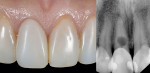 Fig 10. Intraoral clinical image (left) of a patient with a pre-existing composite resin restoration tooth No. 8. Immediate tooth replacement treatment was provided since this tooth had an internal resorption lesion (right).