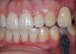 Fig 6. Pre-bleaching shade of the maxillary left canine with a composite button.