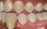 Fig 4. Patient after bleaching of mandibular arch and removal of composite buttons; there was no remaining unbleached area in the button location of tooth No. 21.