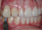 Fig 7. Pre-bleaching shade of the maxillary right canine with a composite button.