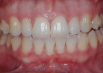 Fig 5. Case 2. Patient prior to clear aligner therapy who was also interested in bleaching.