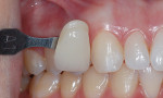 Fig 9. Post-bleaching shade of the maxillary right (Fig 9) and left (Fig 10) canines taken 1 week after removal of the composite buttons demonstrated bleaching occurred under the buttons and throughout each tooth.